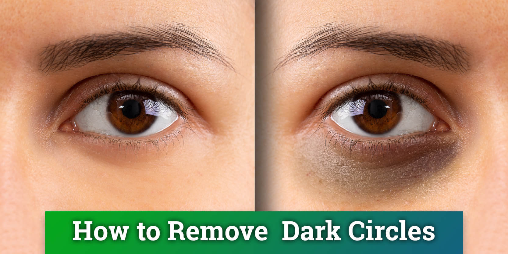 How to remove dark circles under your eyes