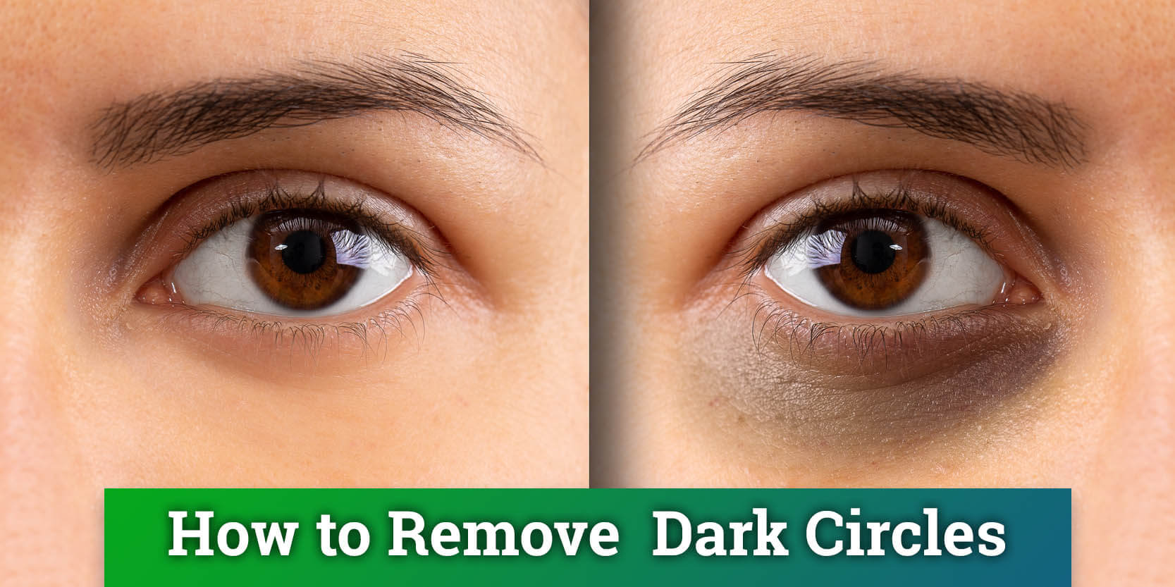 Dark Circles Under Eyes