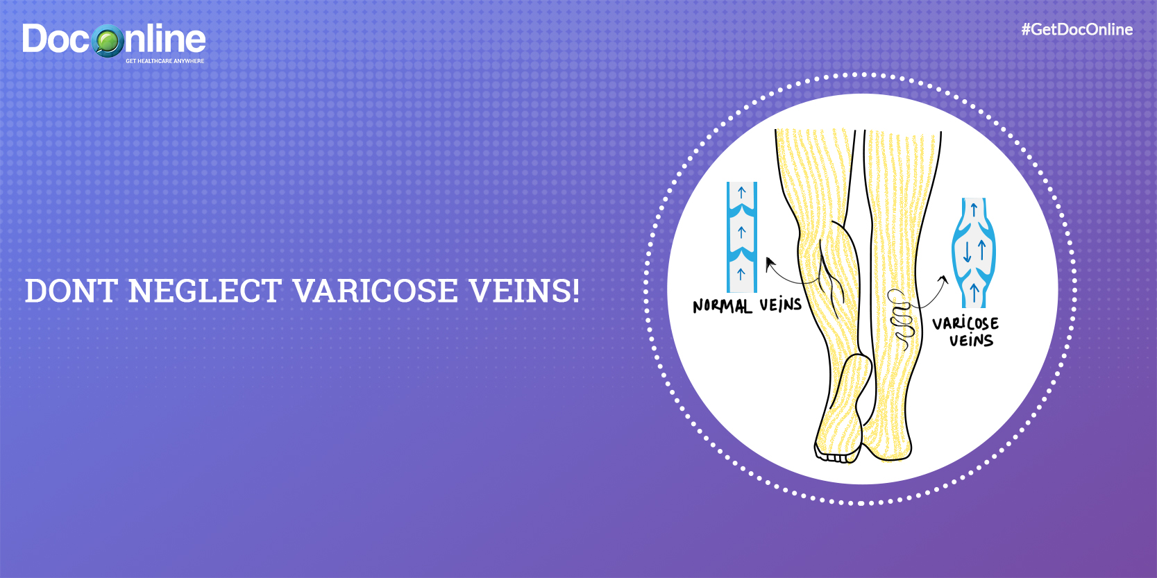 Prevent Varicose